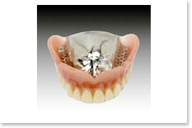 金属床義歯 自費診療