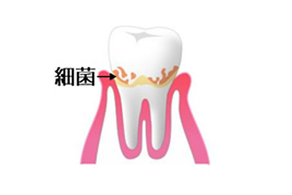 歯磨きをして出血したら、初期歯周病・歯槽膿漏の症状です