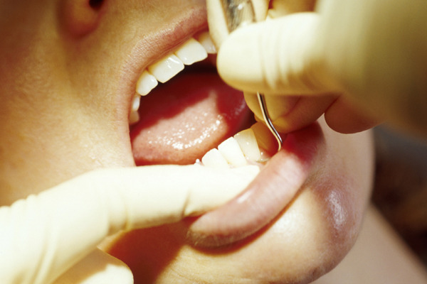 歯周ポケット内に汚れが溜まると歯周病の初期段階です。