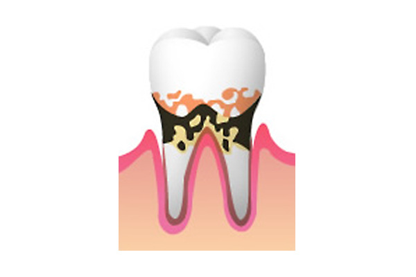 歯がぐらついて口臭がすると重度歯周病・思想膿漏の症状です