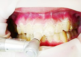 歯のクリーニングを美容感覚で～歯の黄ばみ汚れ落しにも適しています～